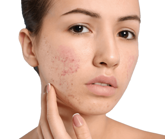 Does Exfoliating Help Acne? I Kate Somerville