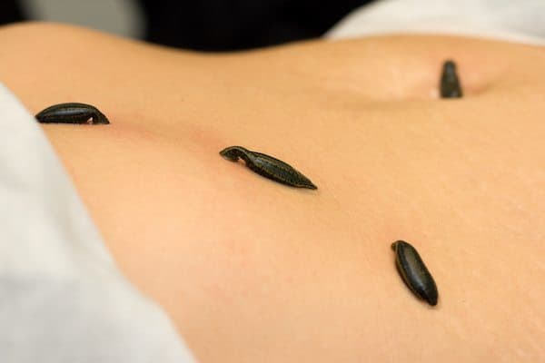 History of Leech Therapy
