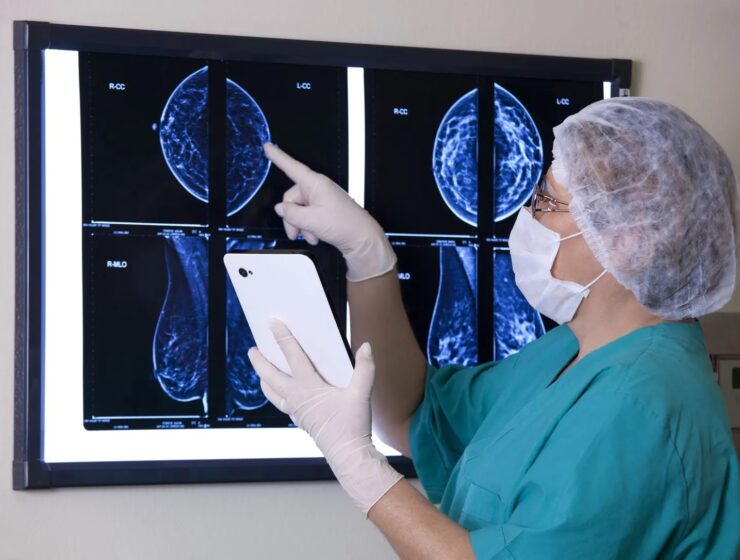 breast cancer mammography