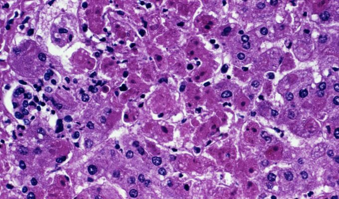 Marburg virus liver injury