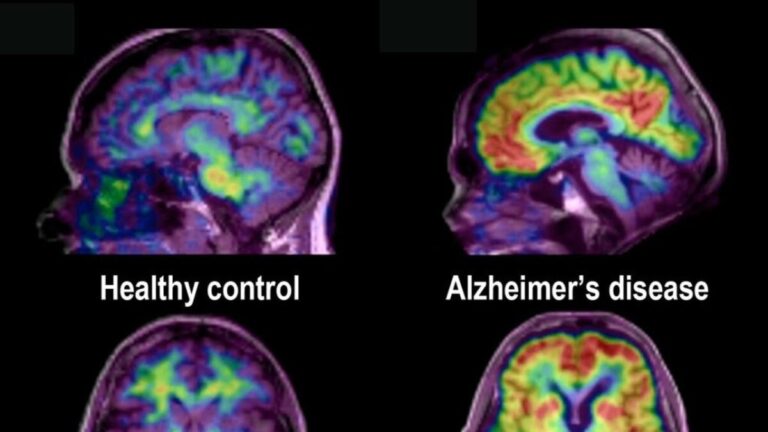 'Breakthrough Alzheimer's drug' 